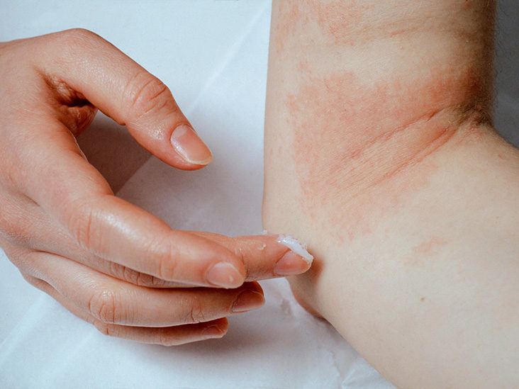 Alternative Treatments to Eczema and Psoriasis